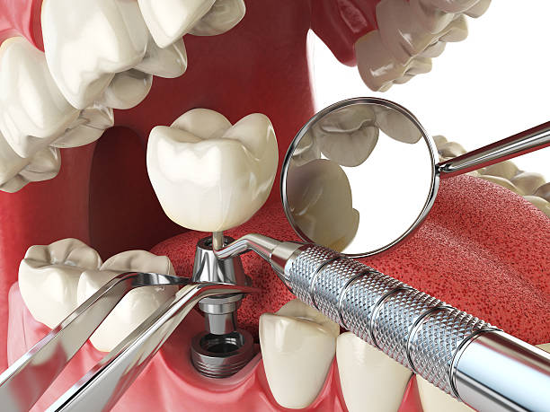 Best Emergency Dentist for Lost Fillings or Crowns in Pine Level, AL